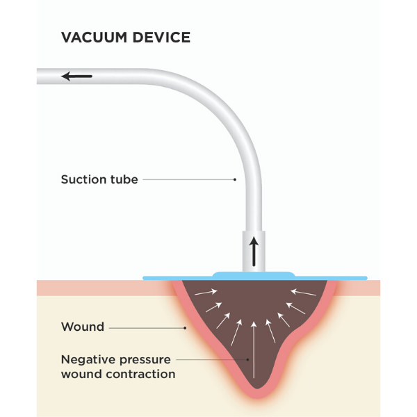 NPWT Diagram